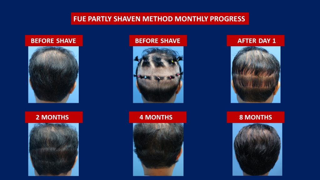 Male Fue Partly Shaven Method