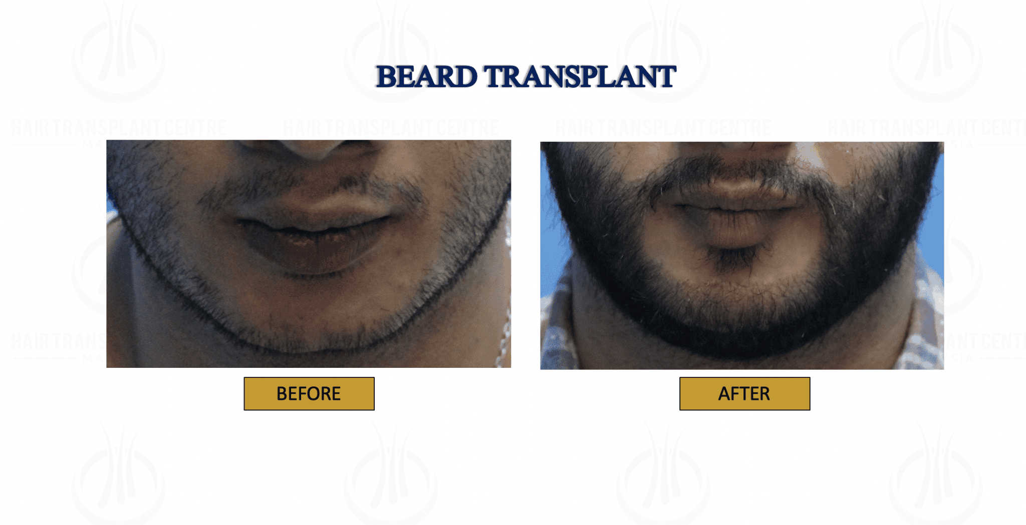 Beard Transplant 2 Klinik Dr Inder