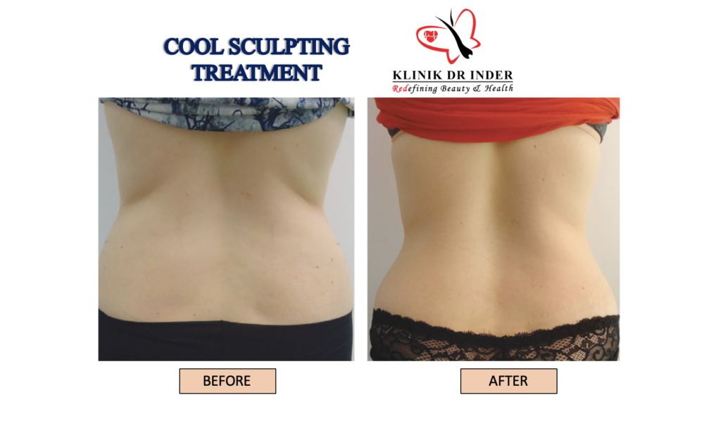 Coolsculpting Treatment Result Before and After