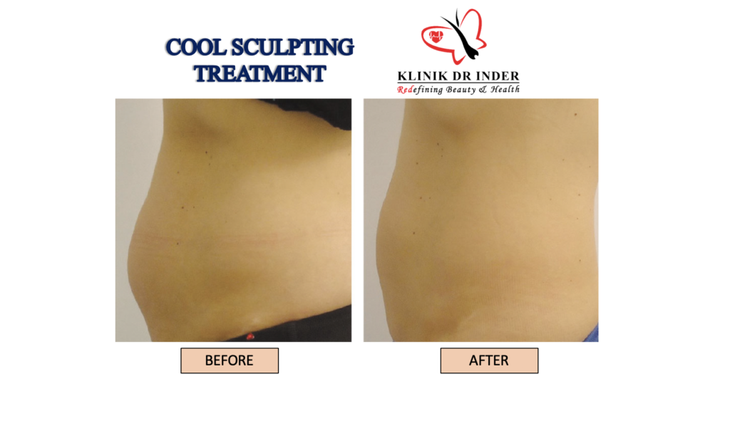 Before and After Result for Coolsculpting Result Treatment