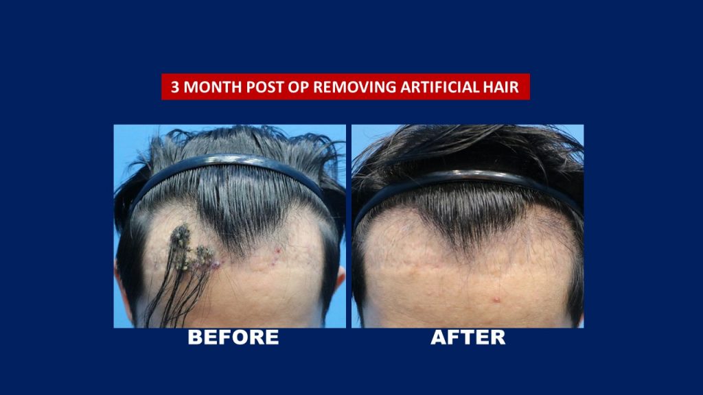 Removing Artificial Hair