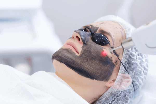 Carbon Laser Peel Treatment