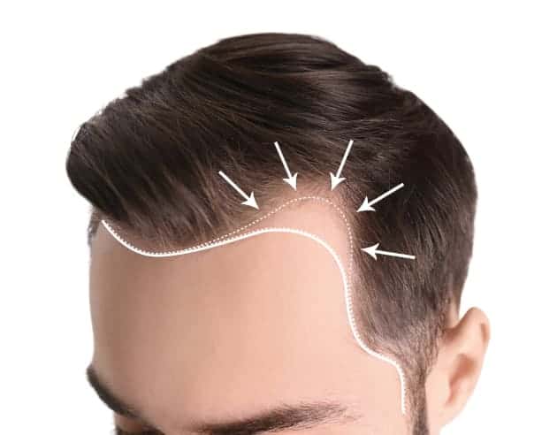 Corrective Hair Transplant Corrective Hair Transplant for Male