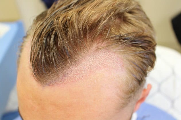 Corrective Hair Transplant 4 Corrective Hair Transplant 4