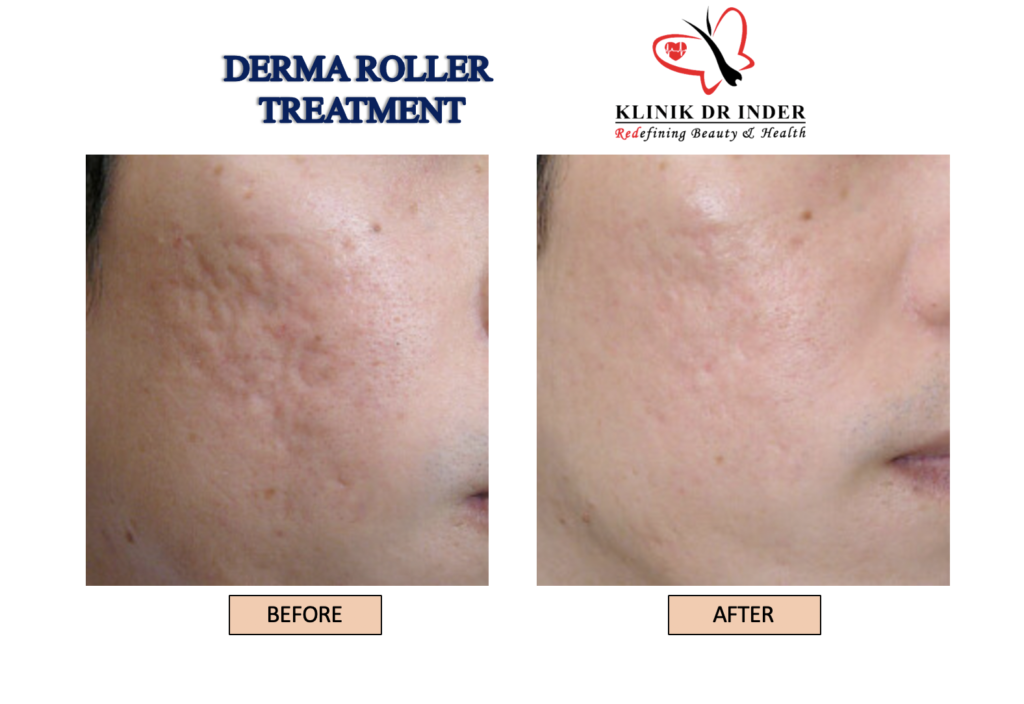 Derma Roller Before and After Treatment