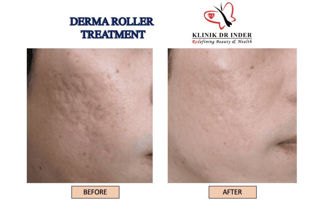 Derma Roller Before and After Treatment