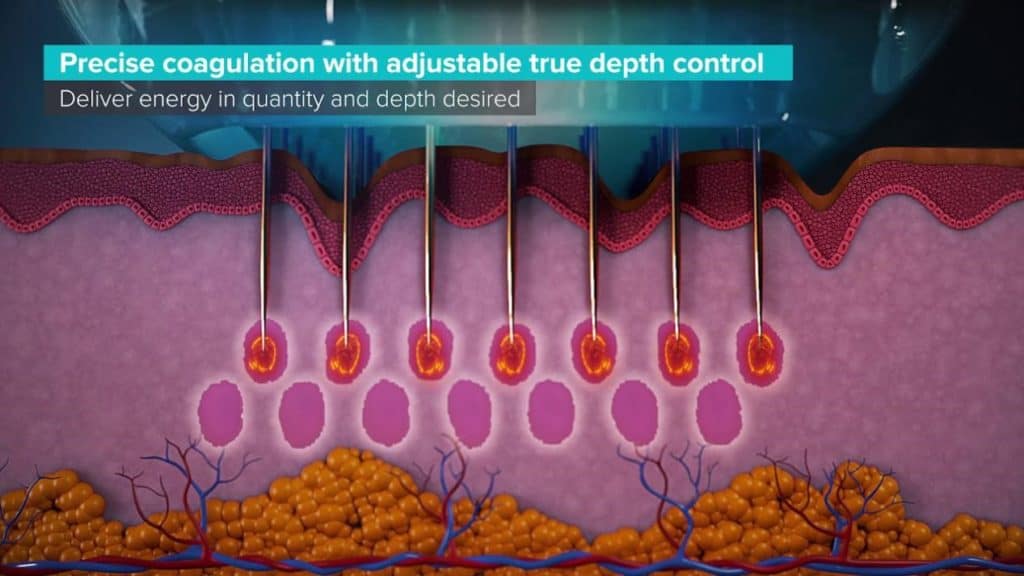 Genius RF Treatment Texture