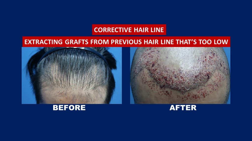 Corrective Hair Line