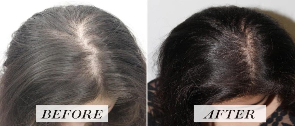 Hair PRP Result Treatment