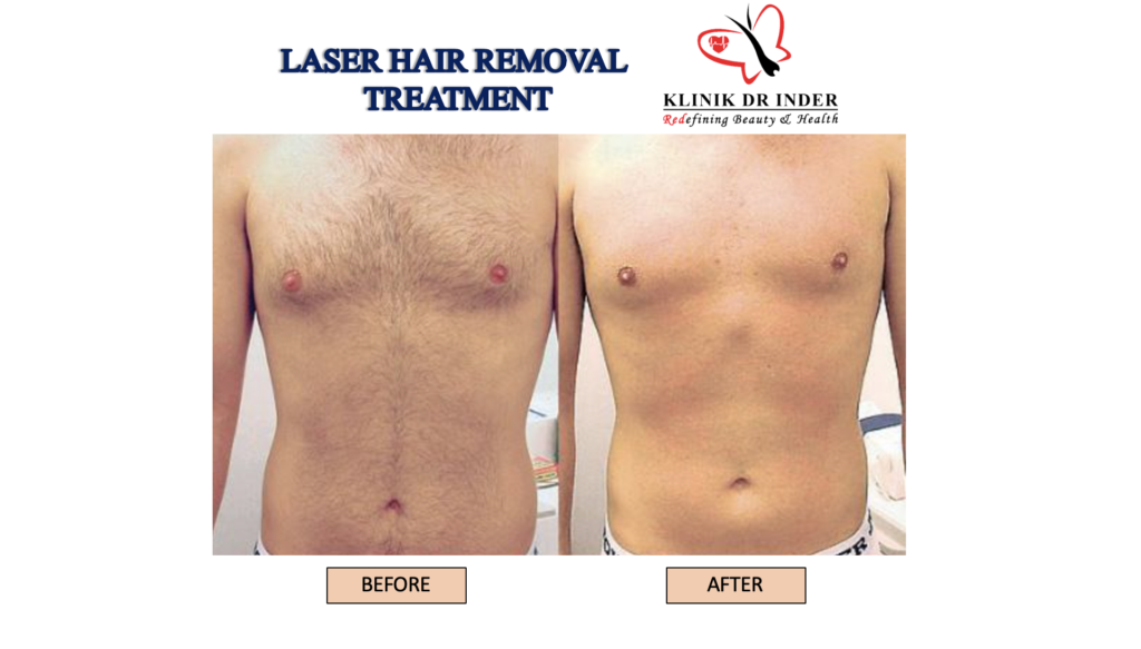 Laser hair Removal Treatment