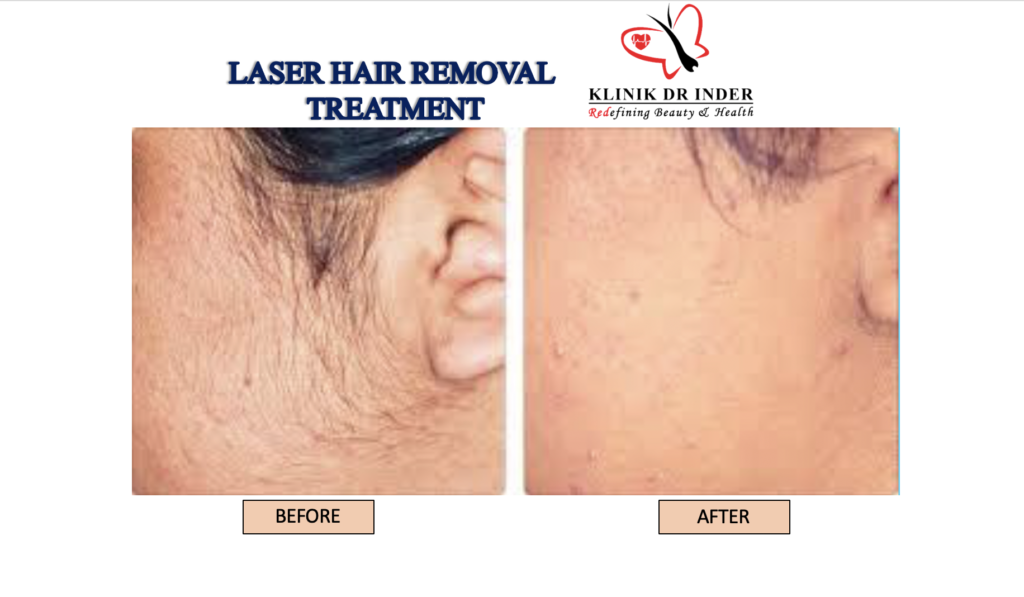 Before and After Result of Laser Hair Removal