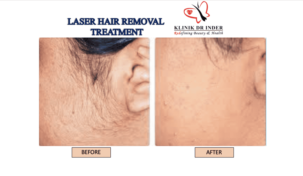 Laser Hair Removal Aestetic Clinic Malysia Proven and Safe