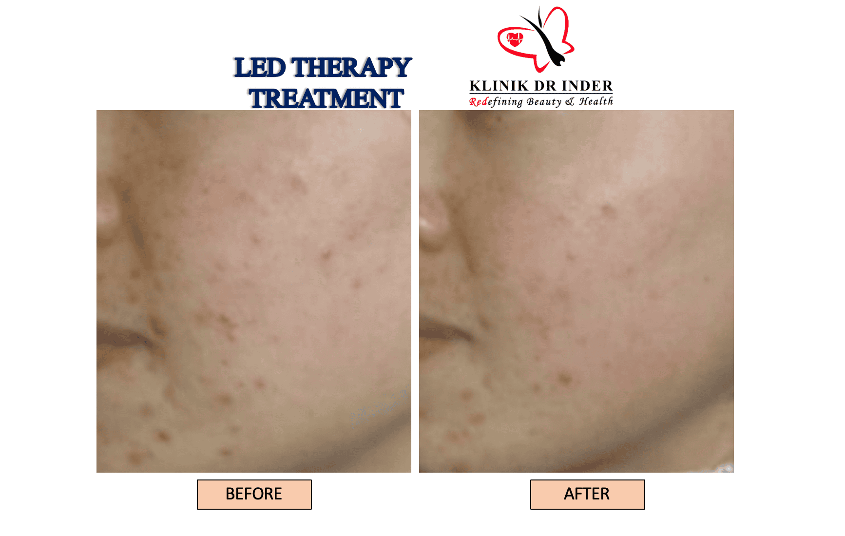 LED Therapy LED Treatment Aesthetic Clinic Malaysia