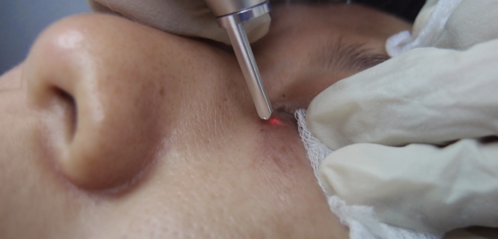 milia seed removal for pigmentation treatment