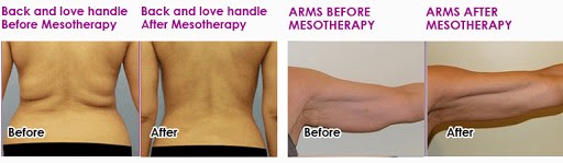 Fat Melting Injection Before and After Treatment