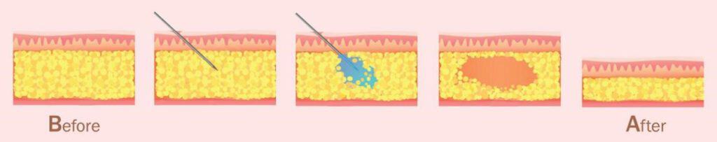 Fat Dissolving Injection
