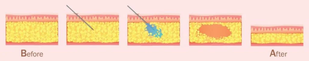 Fat Dissolving Injection