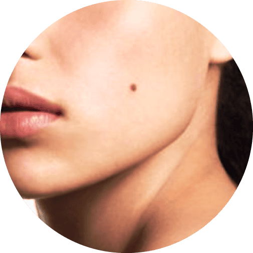 Mole Removal Mole Removal Treatment