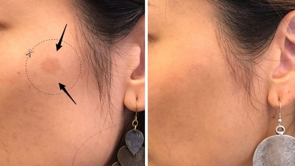 Pico Laser Laser Treatment Skin Imperfections Aesthetic Clinic