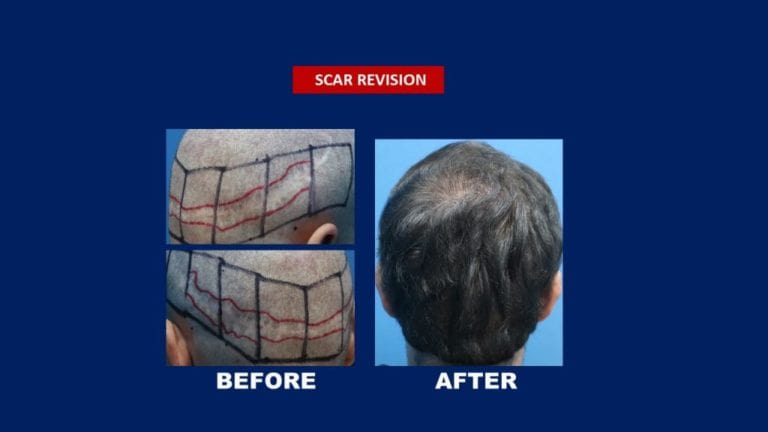 Scar Revision On The Scalp - Using FUE Procedure - Klinik Dr Inder