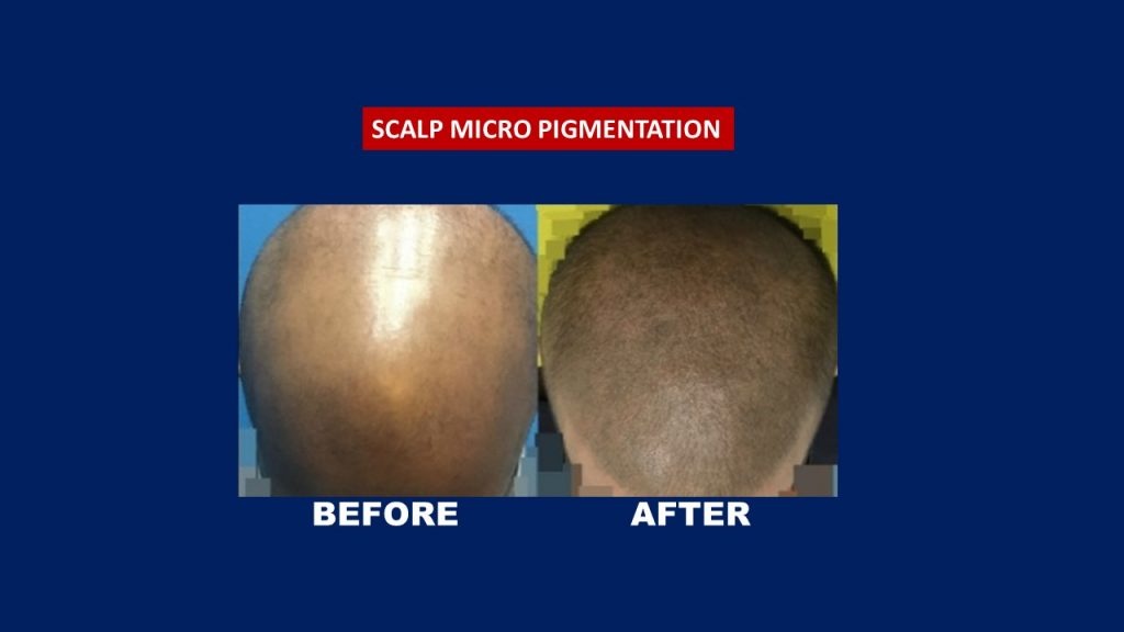 Scalp Micro Pigmentation Result