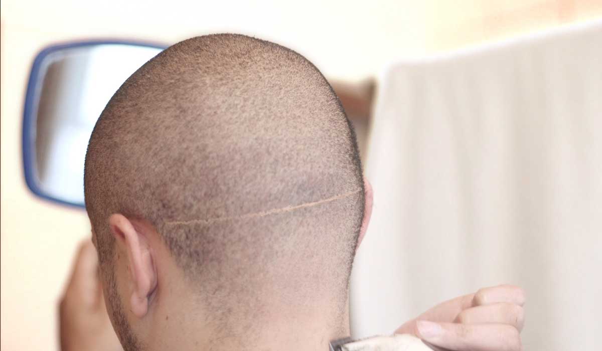 Overal look for Scar Revision On The Scalp Scar Revision On The Scalp
