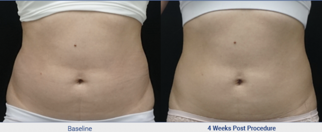Before and After Treatment Result From Clatuu Fat Freezing