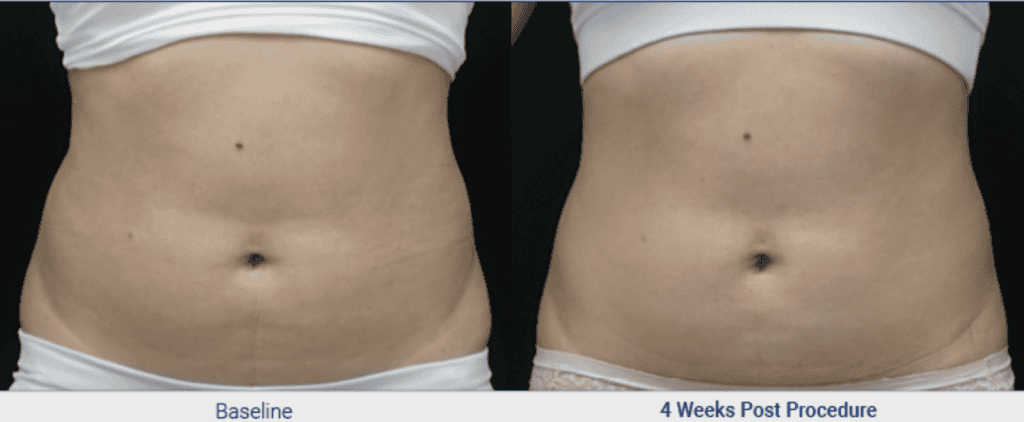 Before and After Treatment Result From Clatuu Fat Freezing