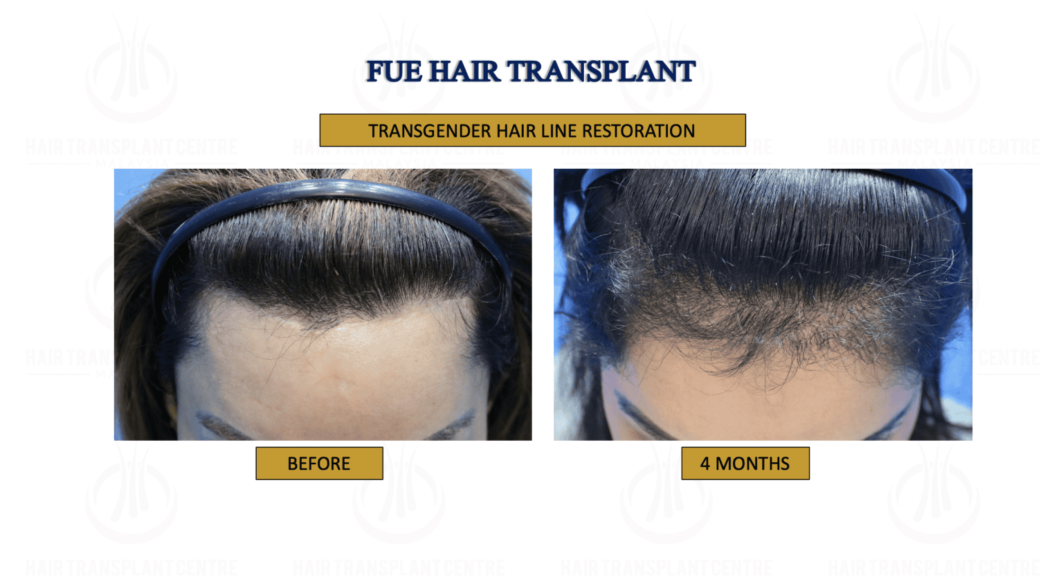 Transgender Hair Transplant - FUE Techniques - Guaranteed Results - Is Hair Transplant Gender Affirming Care