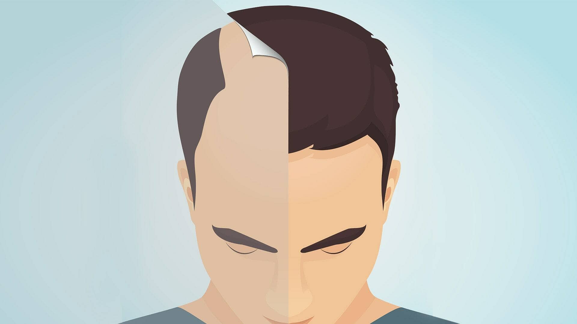 Transgender Hair Transplant 3 Transgender Hair Transplant 3