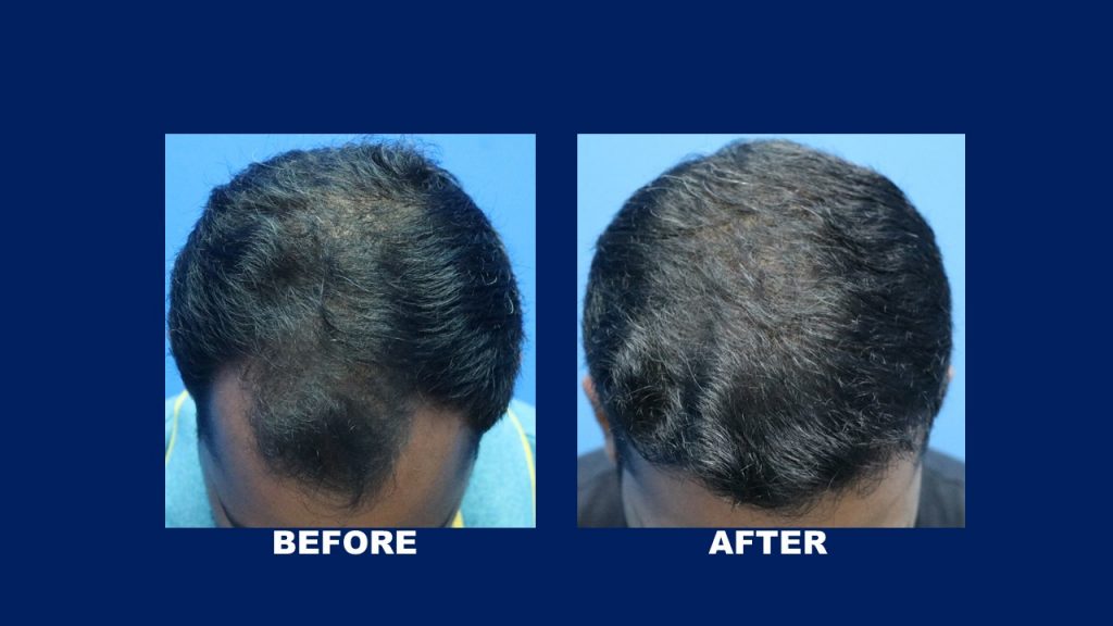 Fue Hair Transplant Result for Male