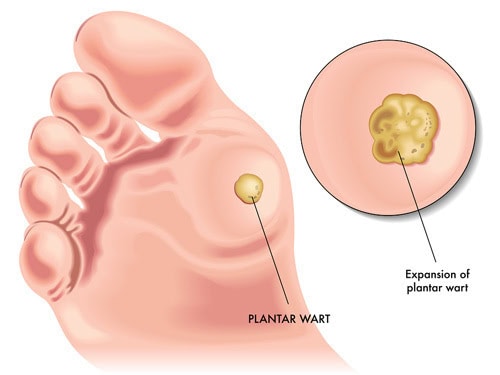 wart removal treatment wart removal treatment