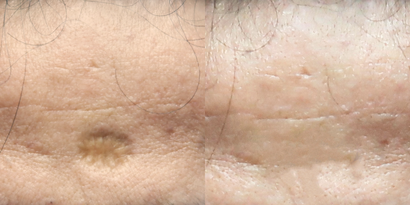 Before and After Treatment Result for Acne Scarring