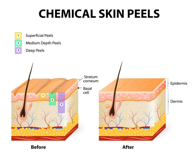 Chemical Peel