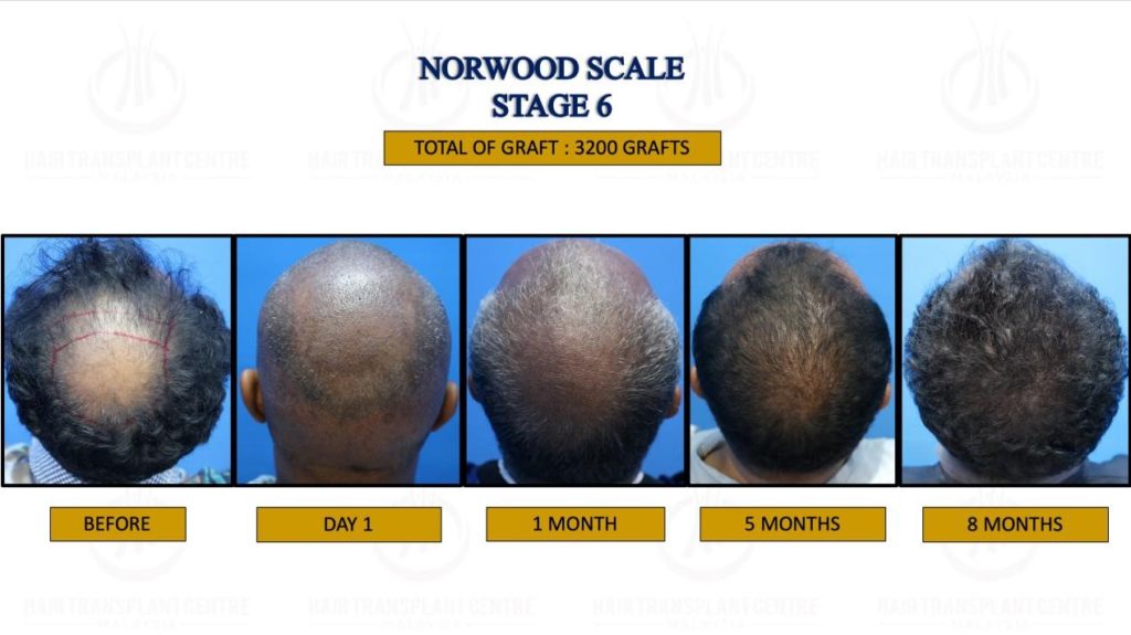 Crown hair Transplant for Norwood Stage 6