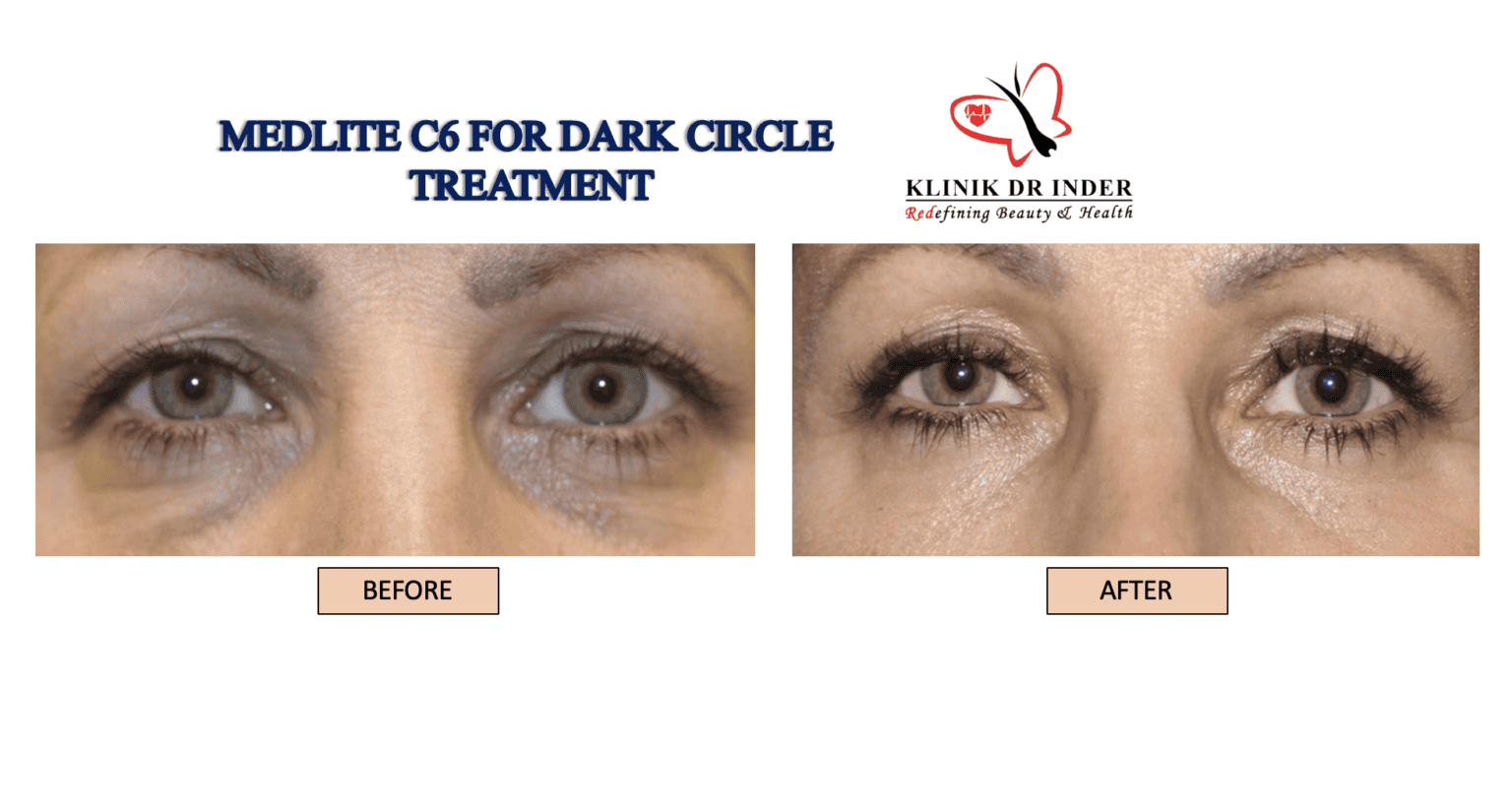 MedLite C6 for Dark Eye Circle Aesthetic Treatment for Dark Eye Circle
