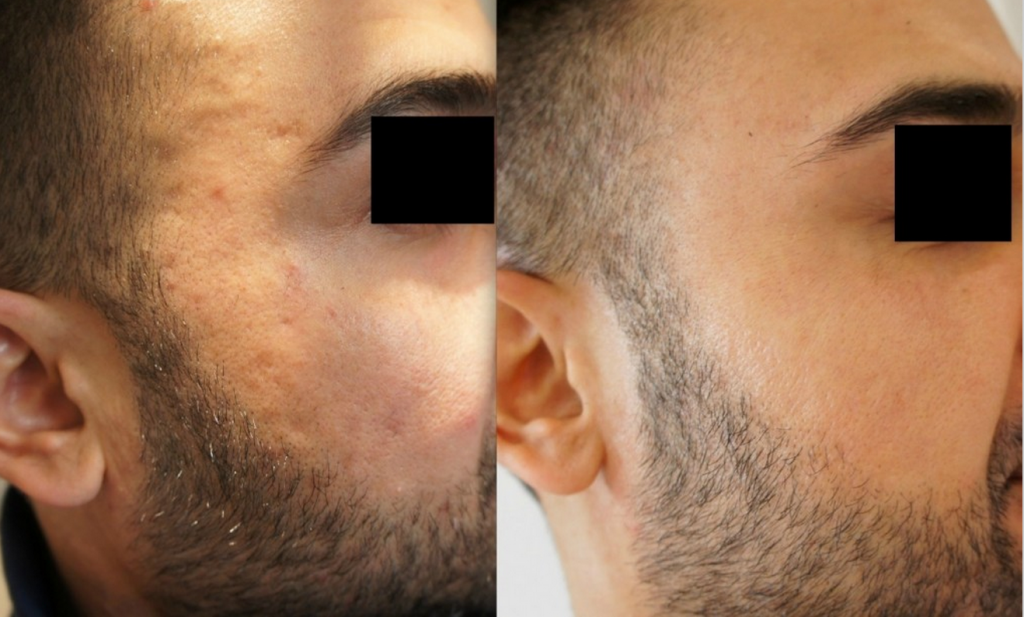 Result of Skin Booster Before and After