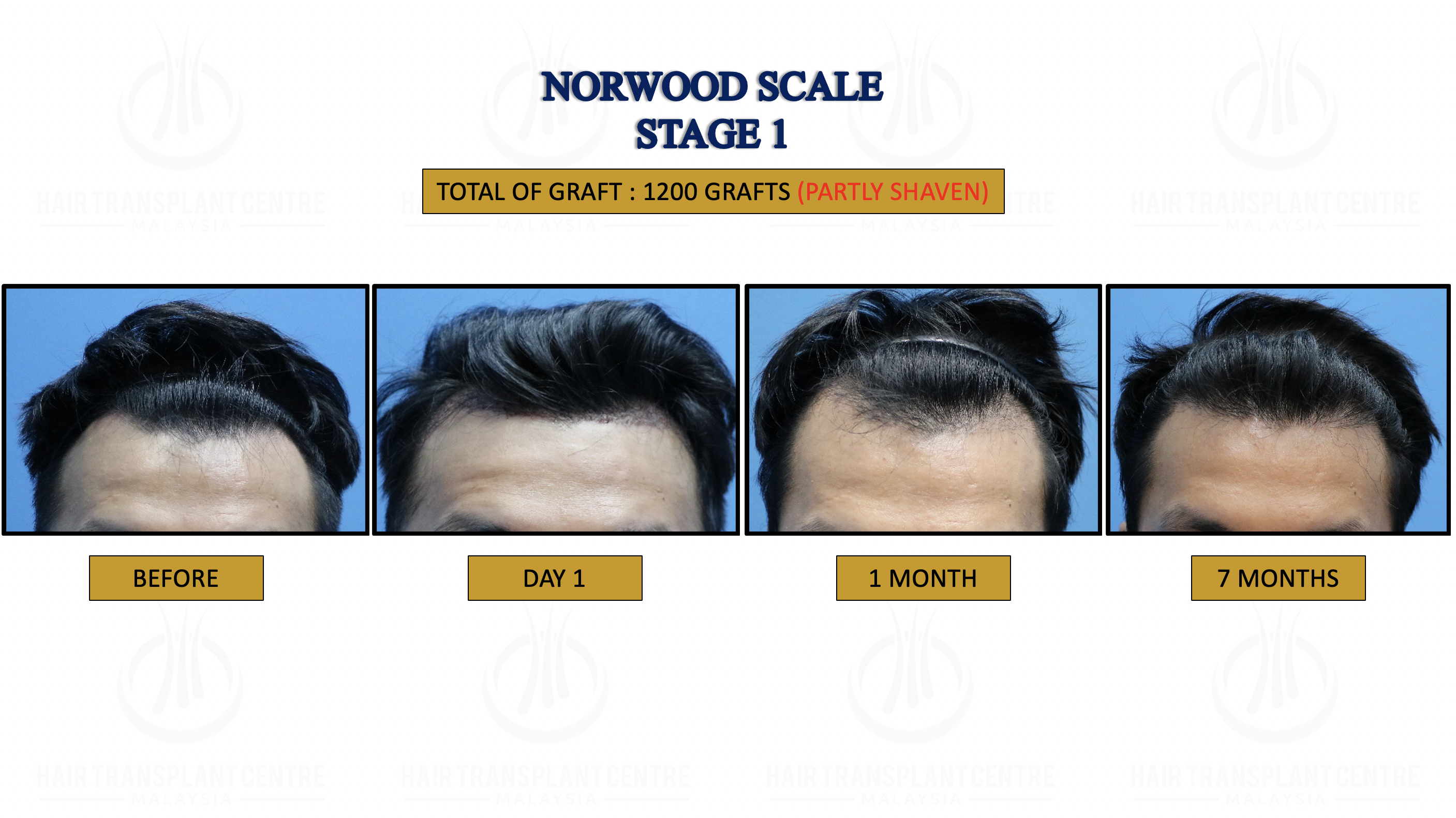 FUE Hair Transplant - Hair Regrowh Treatment - Safe and Proven Result