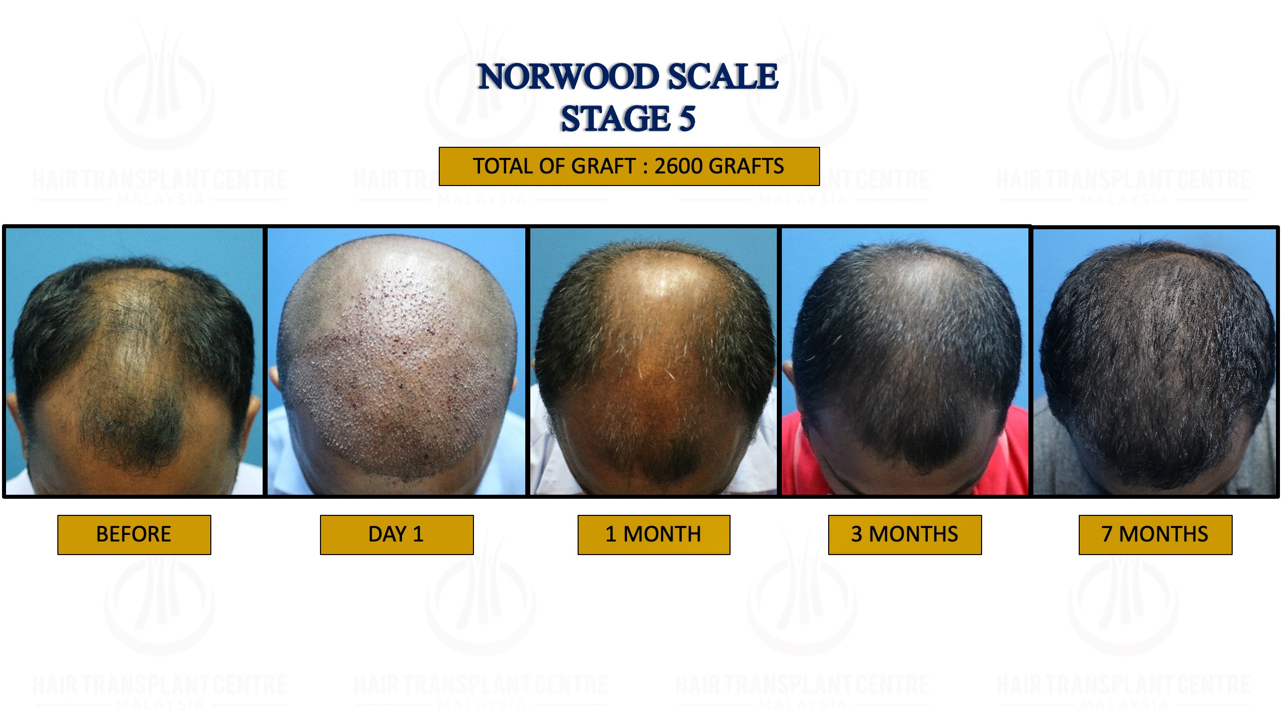 FUE Hair Transplant - Hair Regrowh Treatment - Safe and Proven Result