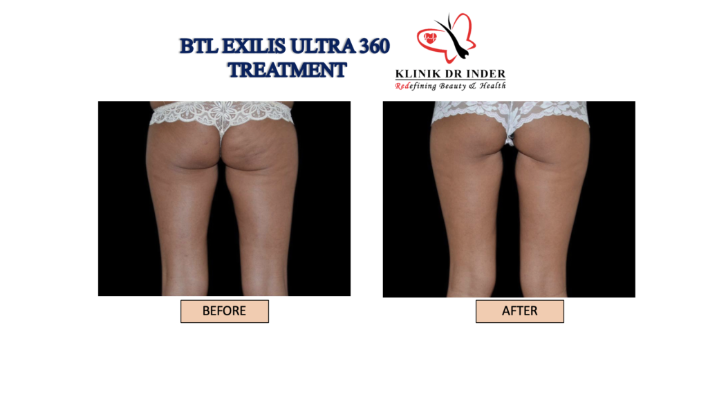 Result Before and After Treatment for Exilis Ultra