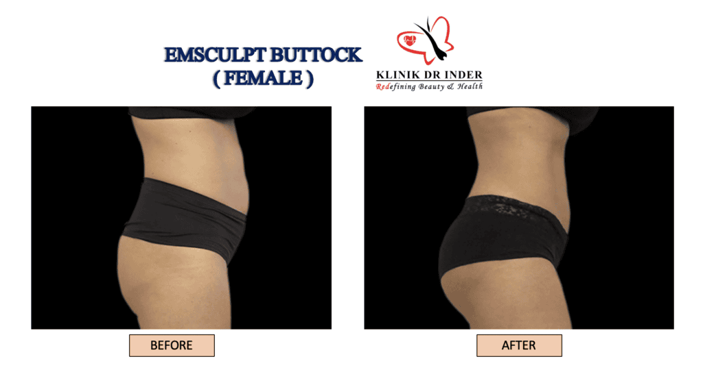 emsculpt buttock result treatment