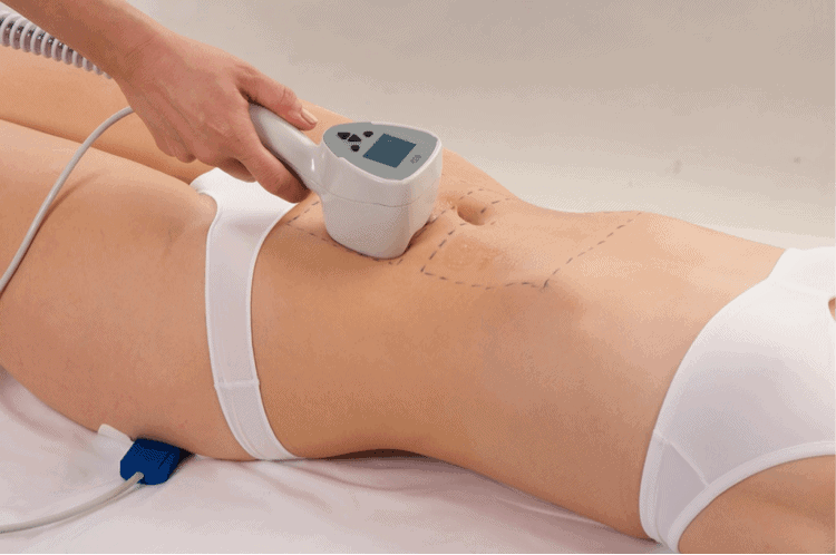 Exilis Ultra 360