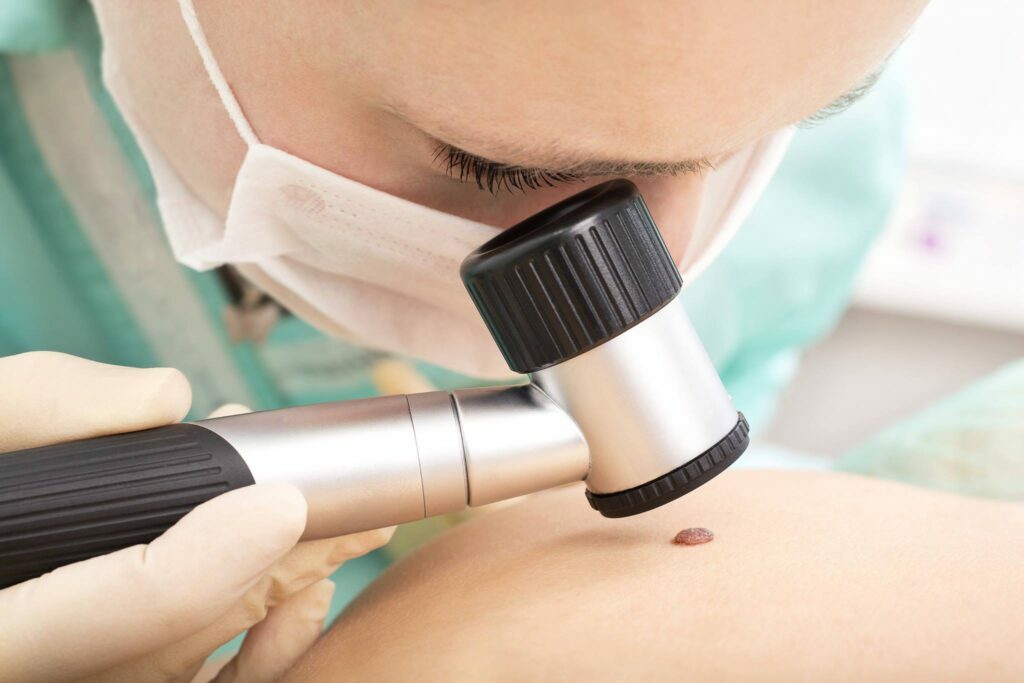 Treatment for Mole Removal