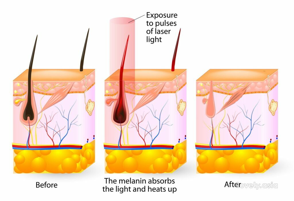 laser hair removal graphic 1