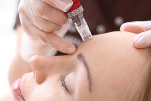 microneedling treatment