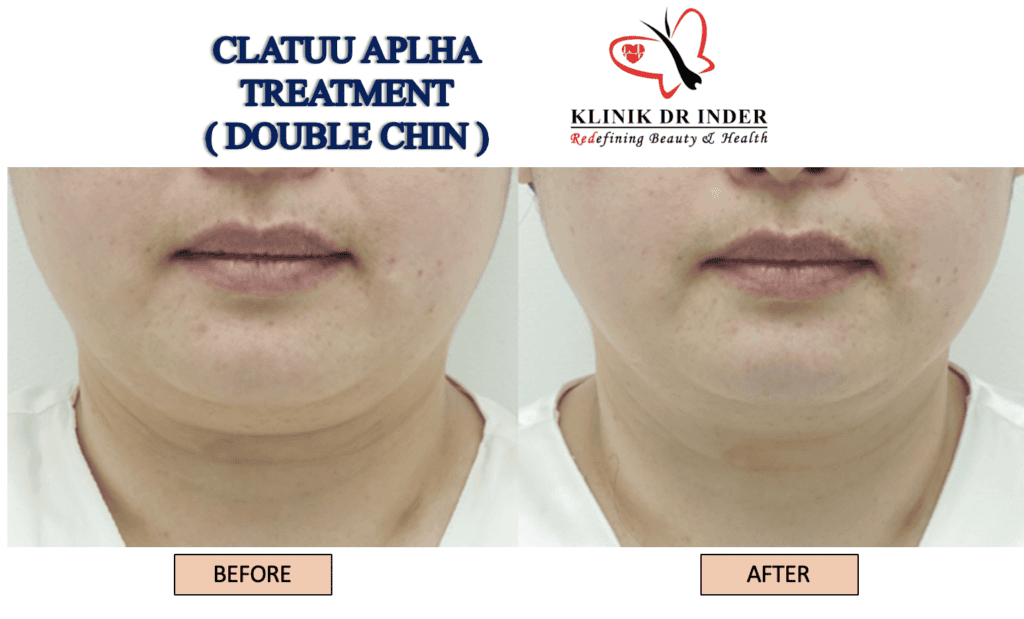 Clatuu Fat Freezing