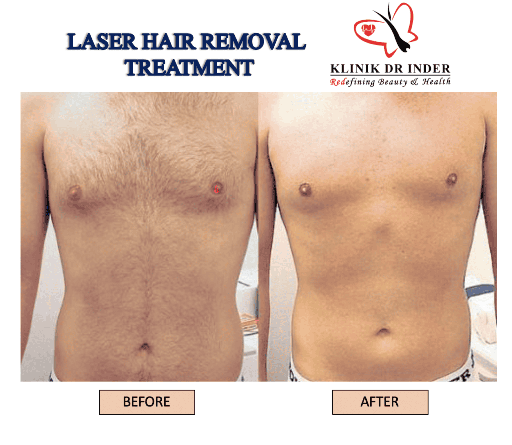 Laser Hair Removal