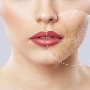 acne treatment.jpg