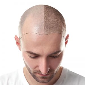 scalp micro pigmentation smp 1.jpg