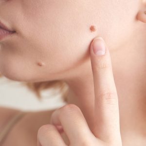 skin tag 1.jpg